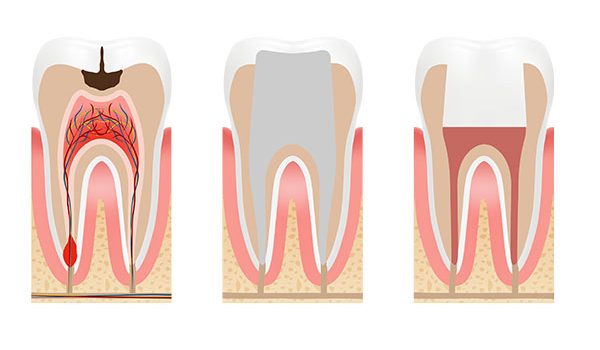 Endodontia - Clínica Dentária New Dente
