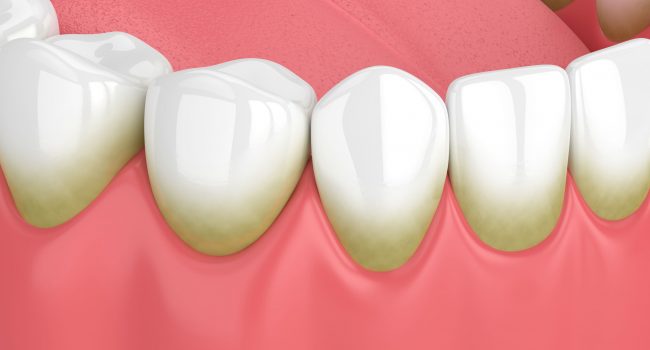 Periodontia - Clínica Dentária New Dente